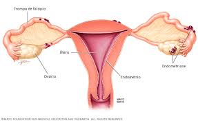 O que é Endometriose?
